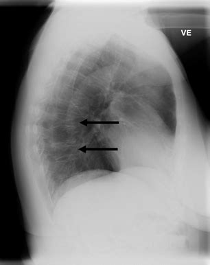 Lateral chest radiograph taken at Sisimiut Hospital on the ...