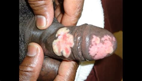 The herpes virus stays in your body forever, even if you have no symptoms. Derm Dx: Penile lesions in an HIV-positive man - Clinical ...