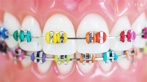 You're not going to want to use your front teeth to bite down into anything. Braces Colors for 2020 - Smile Angels of Beverly Hills