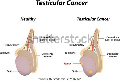 Lump or swelling in the testicle. Testicular Cancer Stock Illustration 229502134