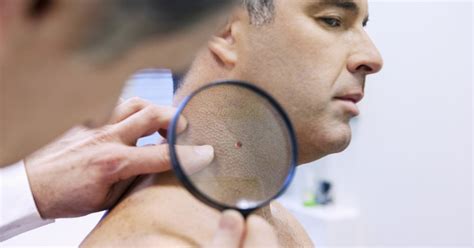 Merkel cell carcinoma (mcc) is a rare and aggressive skin cancer occurring in about 3 people per 1,000,000 members of the population. Learning the Signs and Symptoms of Merkel Cell Cancer ...