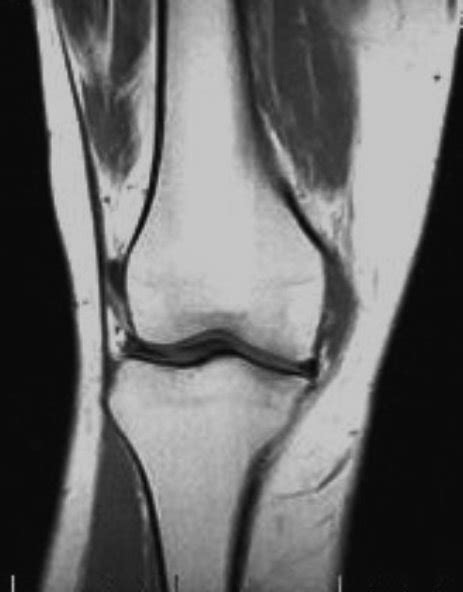 Grade l or mild ligament tear: Medial collateral ligament tear | Image | Radiopaedia.org