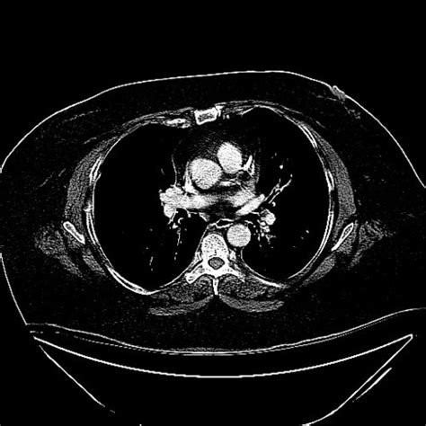 The ribs are a set of twelve paired bones which form the protective 'cage' of the thorax. Lung - Thorax and Ribs CTs - embodi3D.com