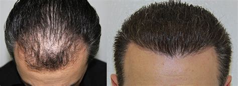 New hair is now visible in the frontal area, but it is sparse and i'm unhappy with the looks. Hair Transplant Repair in Los Angeles, CA - Alvi Armani ...