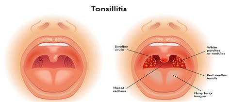 Punca, simpton & cara rawatan semulajadi yang terbaik, cepat & berkesan tanpa pembedahanподробнее. 3 Cara Merawat Tonsil Di Rumah Tanpa Pembedahan