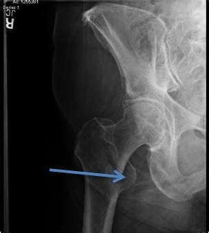 Ultimate computed tomography online training resource! lesser trochanter