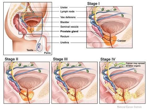 The symptoms of prostate cancer often differ from patient to patient. Prostate Cancer