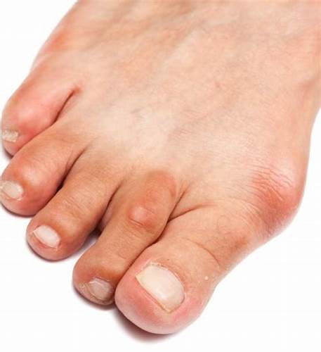 Как снять воспаление на пальце ноги: Лечение панариция пальца ног в Картинка - Как снять воспаление на пальце ноги: Лечение панариция пальца ног в