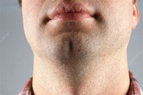 Ice cream in the post: Cleft Chin - Stock Image - C003/4461 - Science Photo Library