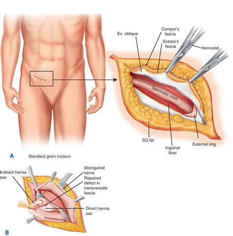 Check spelling or type a new query. What are some guidelines for successful inguinal hernia ...