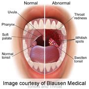 In 2017, 11,336 new cases were diagnosed*. HPV-linked throat cancer may have telltale first symptoms