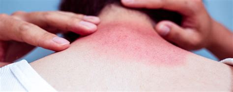 Maybe you would like to learn more about one of these? 7 Hal yang Perlu Dihindari Setelah Kulit Terbakar Matahari ...