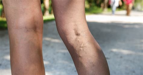 Maybe you would like to learn more about one of these? Varicose Veins and Blood Clots in Your Leg | The Iowa Clinic