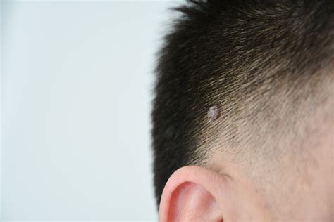 I porri della pelle sono contagiosi? | Prof. Antonino di ...
