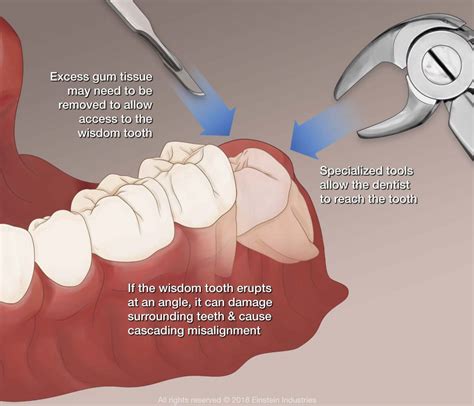 During the initial process, the cost without insurance would be about $300. How Many Wisdom Teeth Does A Person Have - Boston Dentist - Congress Dental Group 160 Federal St ...