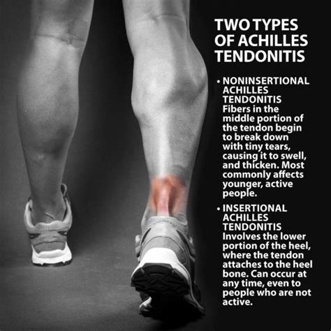 If you tear one of them, or tear a tendon in the back of your thigh, it can bring on sharp pain. Achilles Tendonitis Basics | Florida Orthopaedic Institute