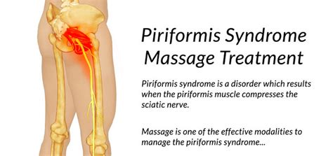 What are the causes of piriformis syndrome? What Is Piriformis Syndrome? Example - Grow Health