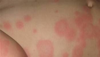 In acuten krankheiten oft vorbote des todes … Eritema Multiforme : Definisi, Penyebab & Diagnosis