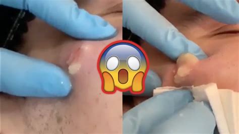 The pimple popping video is one of the most popular variants of this phenomenon, perhaps because it centers on an act so many of us are familiar with the pimple popping community has received a certain amount of mainstream attention thanks to dr. Satisfying Pimple Popping & Blackhead Removal #3 (NEW 2019 ...