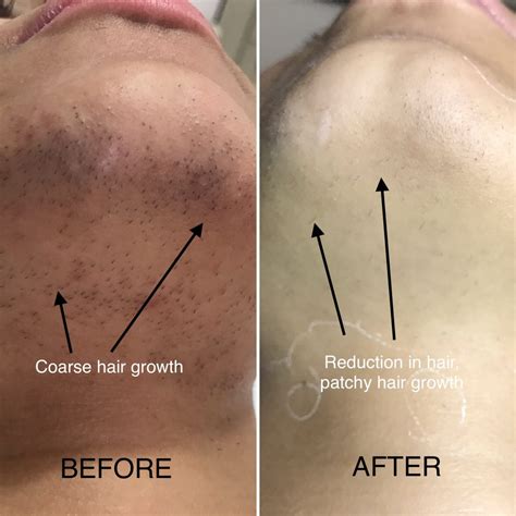 The procedure can be done by itself or along with other cosmetic treatment on the face. DOs and DONTs after a Laser Hair Removal Session ...