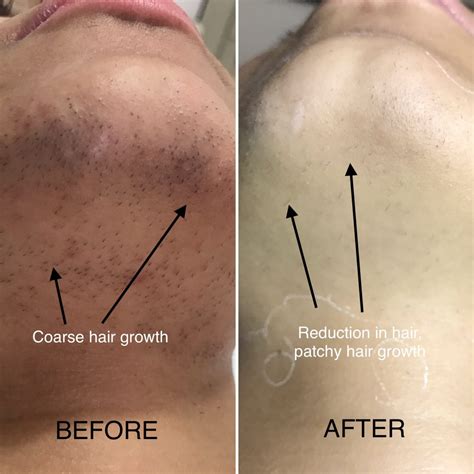 You will likely experience mild redding and swelling around hair follicles after treatment. Sun exposure after laser hair removal > MISHKANET.COM