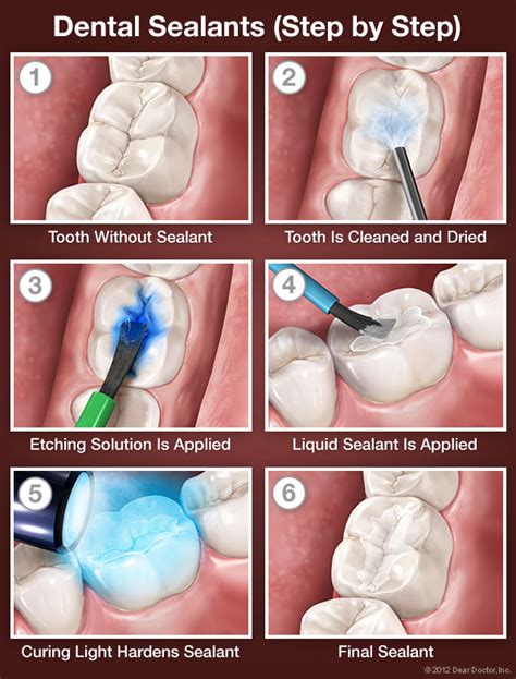 Baby bath procedure step by step : Sigilarea dintilor la copii - Dr. Bogdan Fondrea