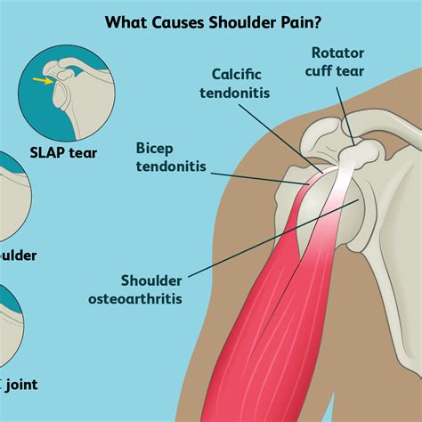 The triceps brachii, as its name indicates, has three heads whose origins are on the scapula and humerus. Rotator Cuff Shoulder Muscles Diagram - Abbathetwiter