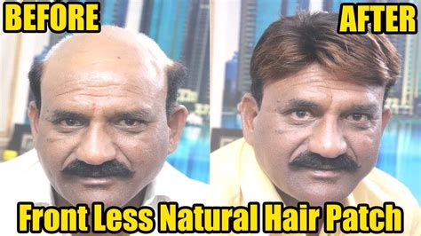 Gray and white hairs often remain where you have hair loss. Hair patch is perfect for men | hair loss problem solve ...