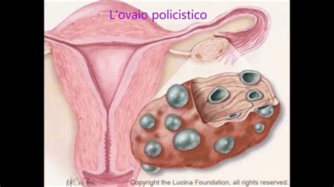 Ovaio policistico e alimentazione sono strettamente collegati, nel senso che esistono dei cibi che sarebbe meglio evitare e dei cibi, al contrario, particolarmente consigliati per chi soffre di. L'ovaio policistico. Cos'è? - YouTube