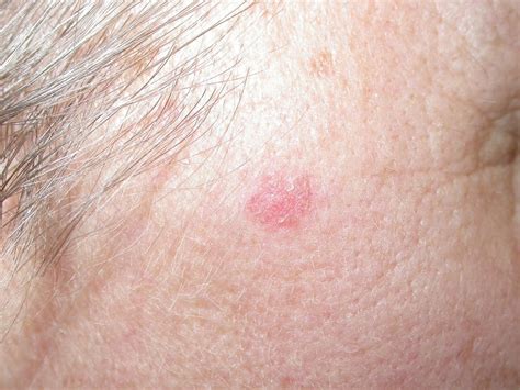 Tnpsc departmental exam 2021 notification out, apply now. Basal Cell Carcinoma | Sutton Dermatology & Aesthetics Ctr
