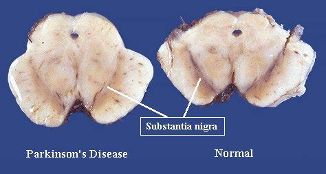 Protection of substantia nigra from mpp+ neurotoxicity by. モナ・ティルチェルヴァン（Mona Thiruchelvam）（米） | 研究者倫理