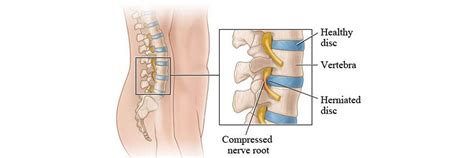 Check spelling or type a new query. Slipped Disc Symptoms and Treeatment | Ayurvedic ...