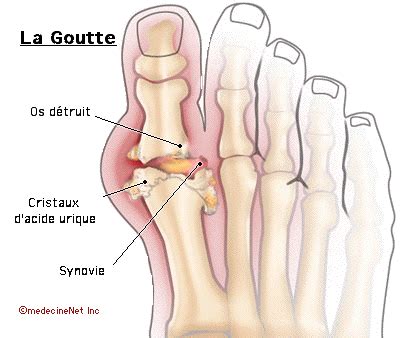 Lorsque le taux d' acide urique sanguin s'élève trop et il y a une concentration trop forte en microcristaux, il précipite et provoque en même temps une inflammation locale. l'acide urique et comment limiter son taux sanguin ...