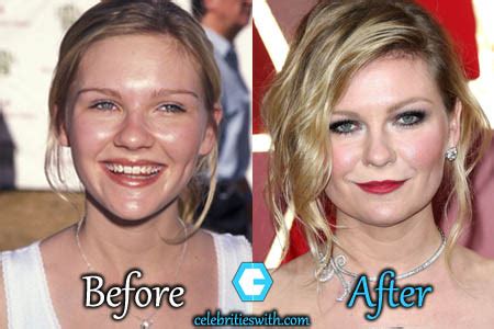 Kirsten dunst plastic surgery and other details about this beautiful actress! Kirsten Dunst Boob Job, Plastic Surgery, Before and After ...