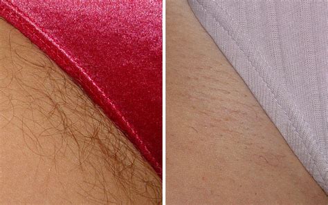 Bikini line area hair removal cost ranges from rs.8,000 to rs.10,000; Laser Hair Removal | Renew Medical Aesthetics - Cheshire ...