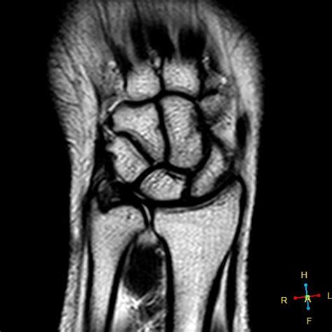 Sections triangular fibrocartilage complex injuries. TFCC injury (Palmer 1b) | Image | Radiopaedia.org