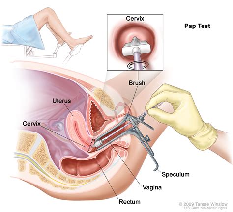 Hpv causes a majority of cervical cancers. Cervical Cancer Screening (PDQ®)-Patient Version ...