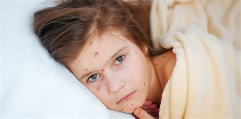 Hauptsymptom der windpocken ist der ausschlag. Ausschlag bei Kindern: welche Krankheit? - HEROLD.at