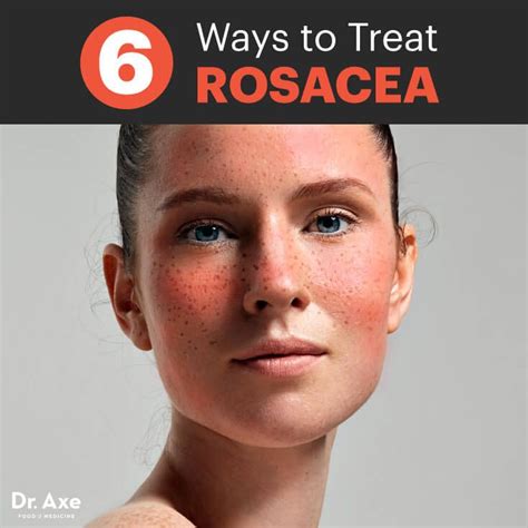 It will teach you natural remedies and what you can do to prevent them. Die besten 25+ Rosacea laser Ideen auf Pinterest | Laser ...