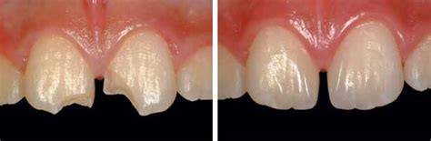 Chipped teeth are a frustrating problem that leave us with pointed jagged teeth, large gaps where you can see the gums, or generally unstraight and unpleasant looking gnashers. Repair Chipped Teeth in Walnut Creek
