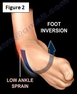 The most well known of these are the lateral and medial ligaments, though some refer to them as lateral and medial collateral ligaments. Chronic Lateral Ankle Instability | HuffPost