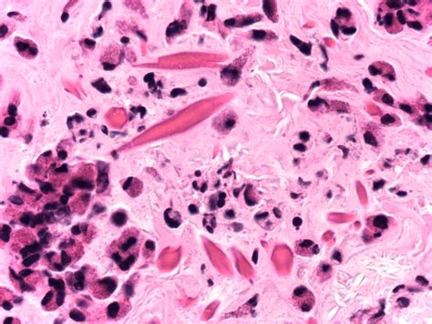 In human body, this protein could spontaneously form. Pathology of Chronic Obstructive Lung Disease