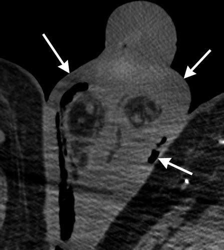 Diabetes mellitus, immunosuppression, alcoholism, recent surgical intervention, trauma, and morbid obesity. Fournier Gangrene: Role of Imaging | RadioGraphics