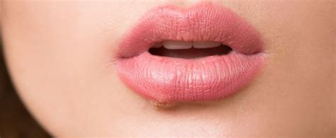 Allerdings erhöhen die oft entzündlichen herpesbläschen das risiko, sich leichter mit anderen geschlechtskrankheiten. Lippenherpes: Fast jeder hat das Herpes-Virus