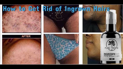 Check spelling or type a new query. How To STOP Ingrown Hairs (Ingrown Hair Prevention) - YouTube