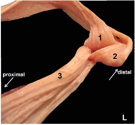 Videos on achilles tendon operations. Dissected left Achilles tendon, superior view. (1) The ...