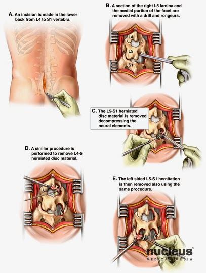 Ia disebabkan kandungan di dalam cakera intervertebra iaitu nucleus polposus terkeluar dan rawatan bagi slipped disc terbahagi kepada dua iaitu rawatan sokongan dan juga pembedahan. jihajumi: RAWATAN SLIP DISC