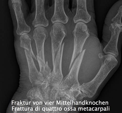 Fratture e distorsioni della mano - Dr. Frank NienstedtDr ...