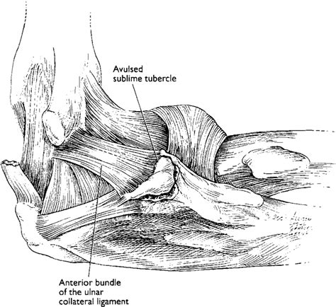 Medial view of the elbow showing the anterior bundle of ...
