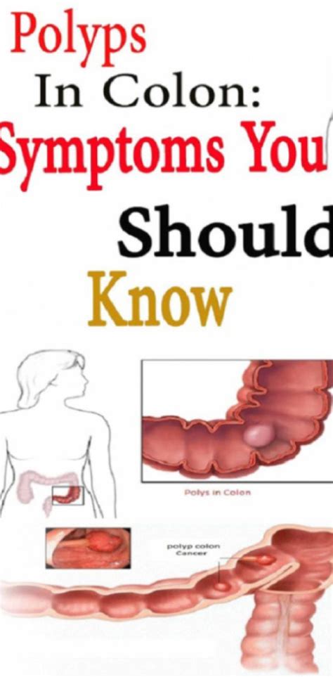Here in this article, we are going to know the signs and symptoms of this colon cancer and how to overcome this problem with an early treatment to get faster recovery. COLON POLYPS: SYMPTOMS YOU SHOULD NEVER IGNORE !!! in 2020 ...